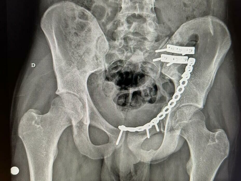 Imagem copia 399110979fratura acetabulo